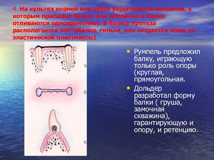 4. На культях корней или зубах укрепляются колпачки, к которым припаяна