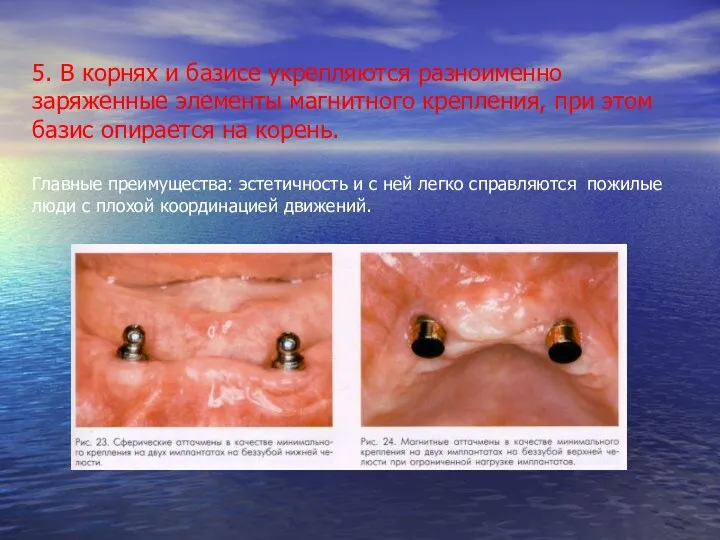 5. В корнях и базисе укрепляются разноименно заряженные элементы магнитного крепления,