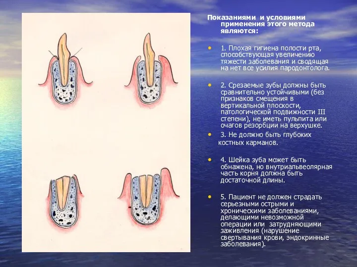 Показаниями и условиями применения этого метода являются: 1. Плохая гигиена полости
