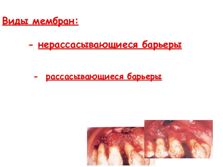 Виды мембран: - нерассасывающиеся барьеры - рассасывающиеся барьеры