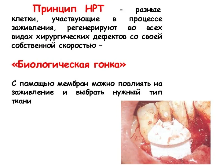 Принцип НРТ - разные клетки, участвующие в процессе заживления, регенерируют во