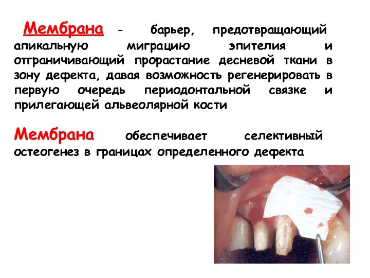 Мембрана – барьер, предотвращающий апикальную миграцию эпителия и отграничивающий прорастание десневой