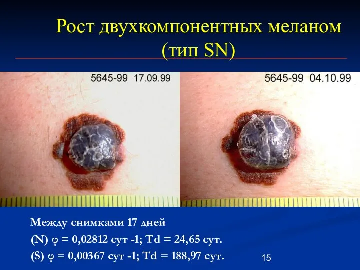 Рост двухкомпонентных меланом (тип SN) Между снимками 17 дней (N) φ