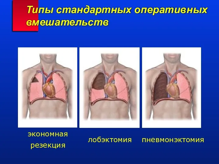 Типы стандартных оперативных вмешательств экономная резекция лобэктомия пневмонэктомия