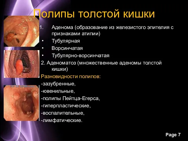 Полипы толстой кишки Аденома (образование из железистого эпителия с признаками атипии)