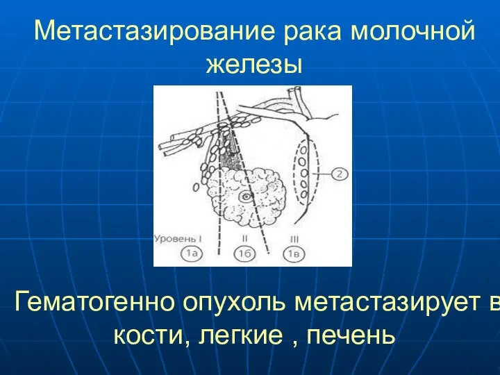 Метастазирование рака молочной железы Гематогенно опухоль метастазирует в кости, легкие , печень