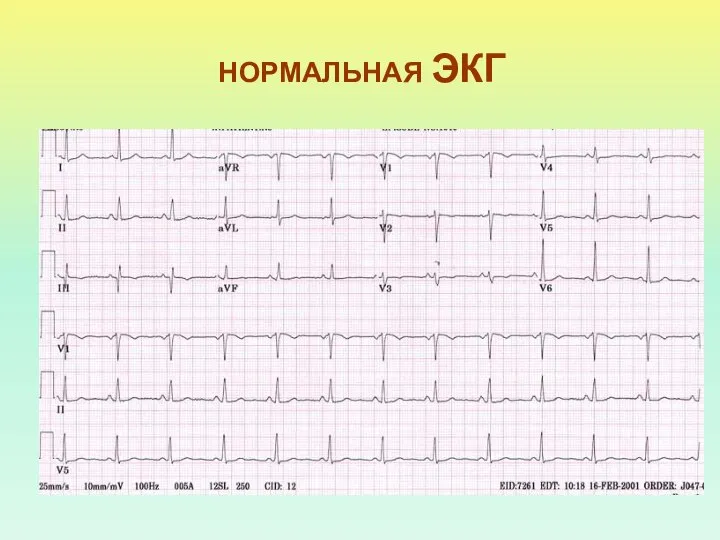 НОРМАЛЬНАЯ ЭКГ