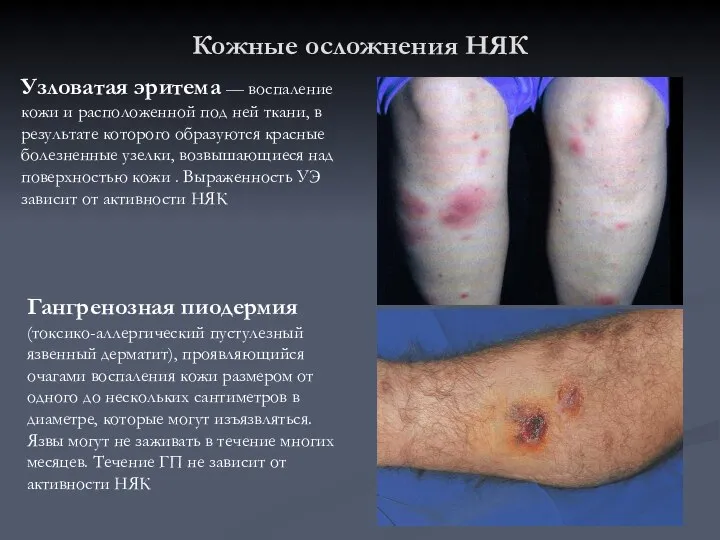 Кожные осложнения НЯК Узловатая эритема — воспаление кожи и расположенной под