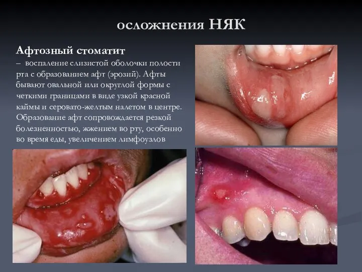 осложнения НЯК Афтозный стоматит – воспаление слизистой оболочки полости рта с