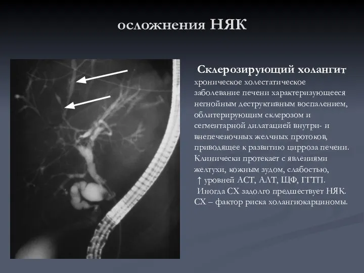 осложнения НЯК Склерозирующий холангит хроническое холестатическое заболевание печени характеризующееся негнойным деструктивным