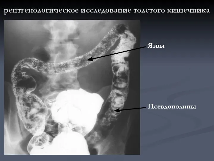 рентгенологическое исследование толстого кишечника Псевдополипы Язвы