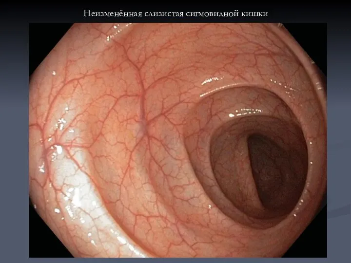 Неизменённая слизистая сигмовидной кишки