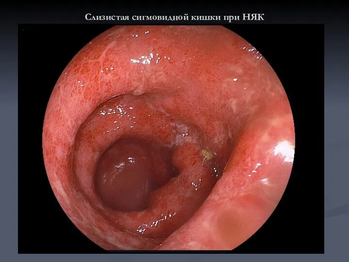 Слизистая сигмовидной кишки при НЯК
