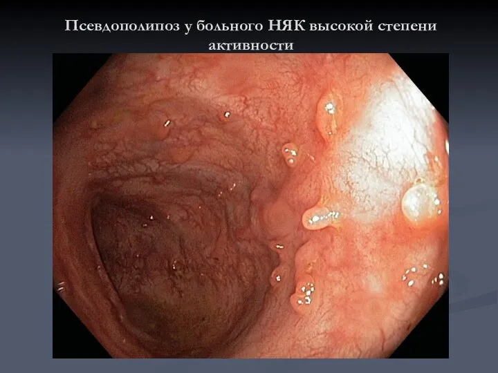 Псевдополипоз у больного НЯК высокой степени активности