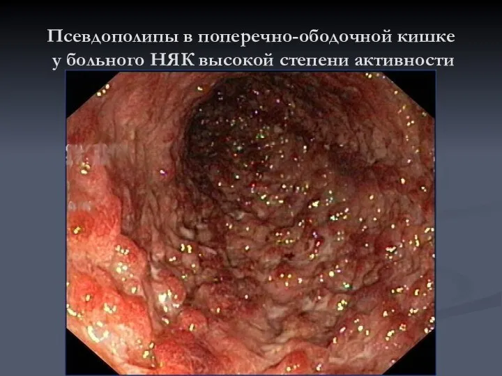 Псевдополипы в поперечно-ободочной кишке у больного НЯК высокой степени активности