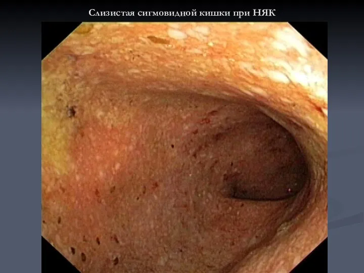 Слизистая сигмовидной кишки при НЯК