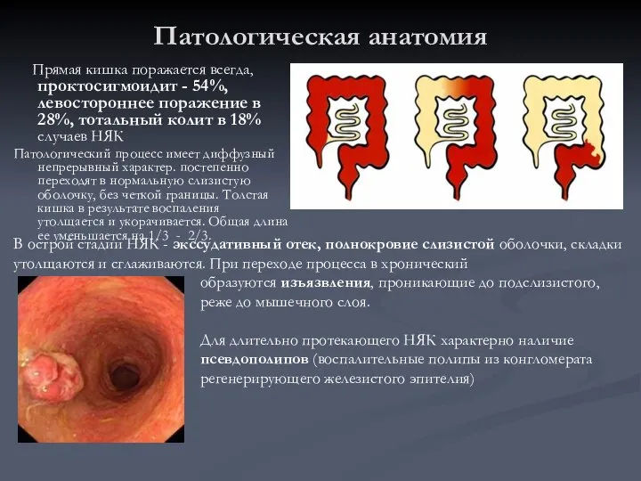 Патологическая анатомия Прямая кишка поражается всегда, проктосигмоидит - 54%, левостороннее поражение