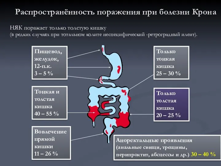 Распространённость поражения при болезни Крона Пищевод, желудок, 12-п.к. 3 – 5