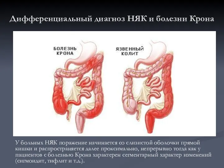 Дифференциальный диагноз НЯК и болезни Крона У больных НЯК поражение начинается