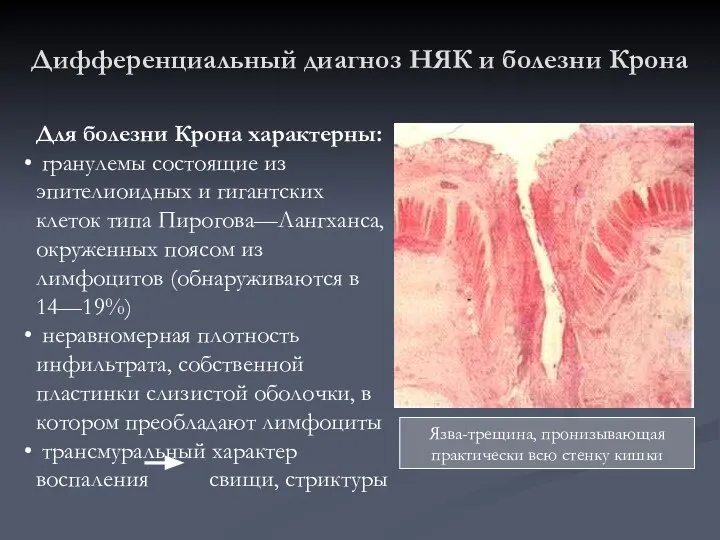 Дифференциальный диагноз НЯК и болезни Крона Для болезни Крона характерны: гранулемы