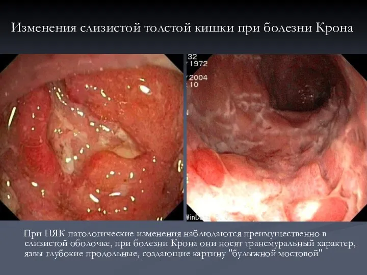 При НЯК патологические изменения наблюдаются преимущественно в слизистой оболочке, при болезни