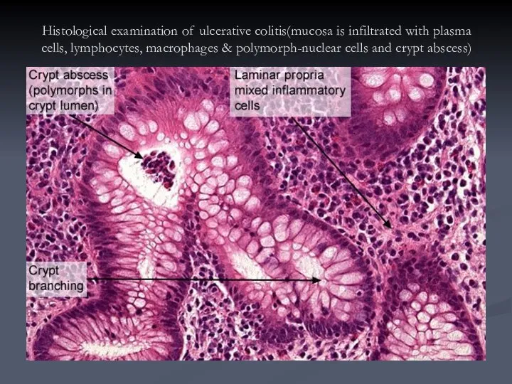 Histological examination of ulcerative colitis(mucosa is infiltrated with plasma cells, lymphocytes,