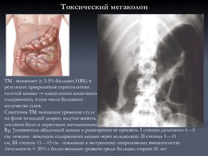 Токсический мегаколон Rg: ↑пневматоза ободочной кишки и расширение ее просвета. I