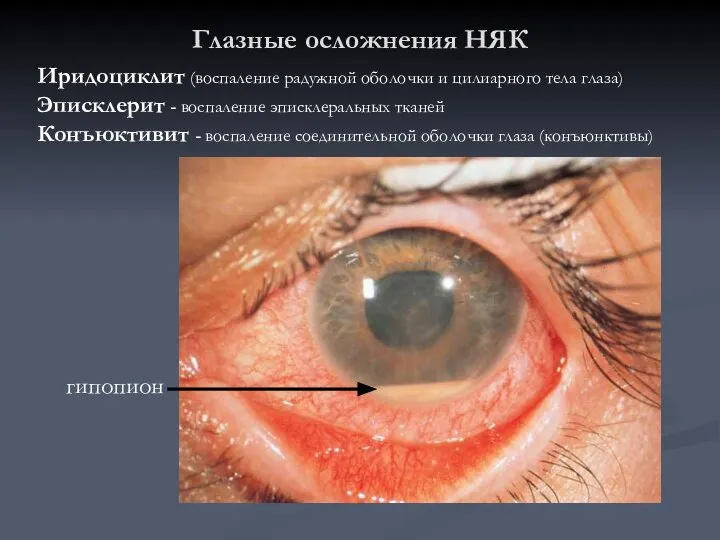 Глазные осложнения НЯК Иридоциклит (воспаление радужной оболочки и цилиарного тела глаза)