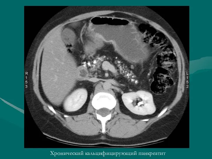 Хронический кальцифицирующий панкреатит