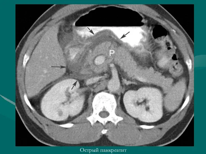 Острый панкреатит