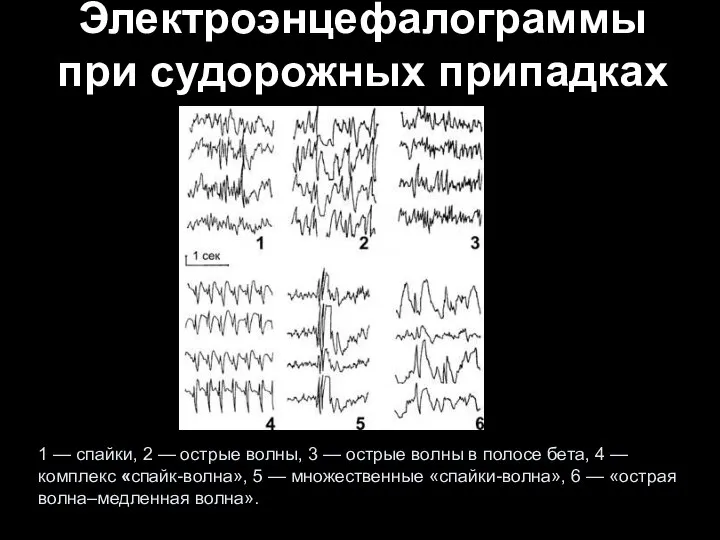 Электроэнцефалограммы при судорожных припадках 1 — спайки, 2 — острые волны,