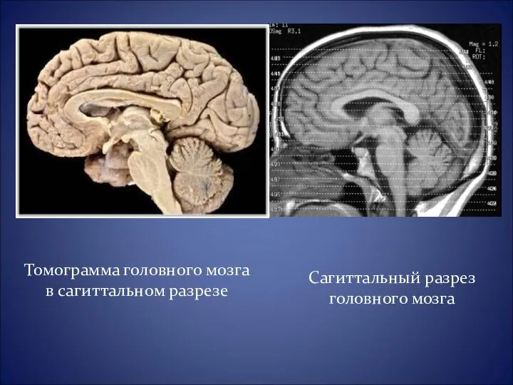 Сагиттальный разрез головного мозга Томограмма головного мозга в сагиттальном разрезе