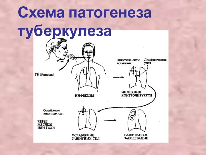 Схема патогенеза туберкулеза