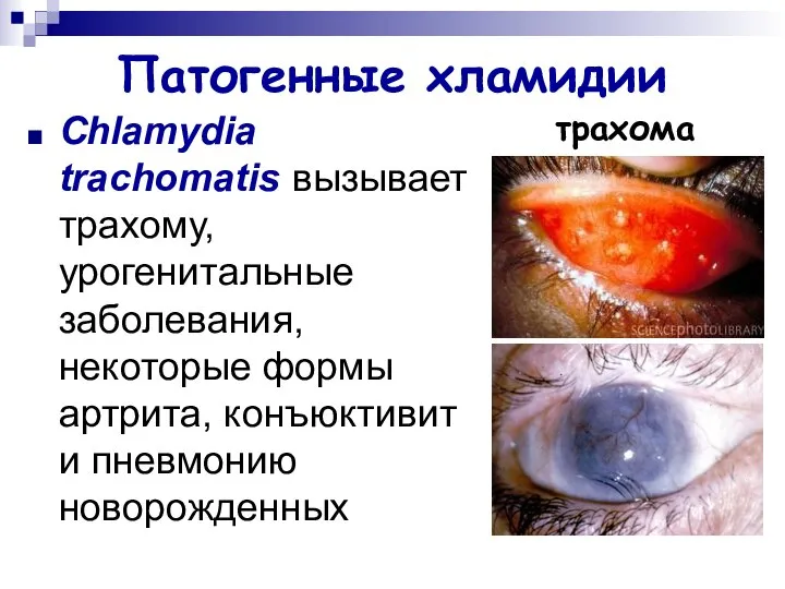 Патогенные хламидии Chlamydia trachomatis вызывает трахому, урогенитальные заболевания, некоторые формы артрита, конъюктивит и пневмонию новорожденных трахома