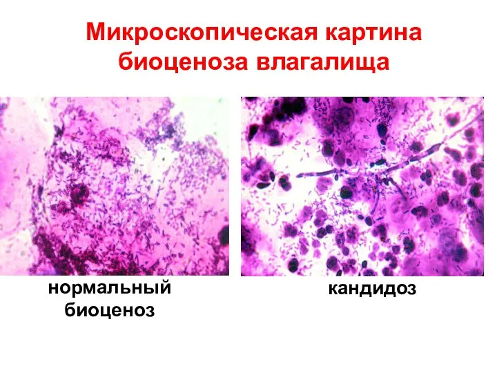 нормальный биоценоз кандидоз Микроскопическая картина биоценоза влагалища