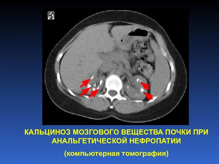 КАЛЬЦИНОЗ МОЗГОВОГО ВЕЩЕСТВА ПОЧКИ ПРИ АНАЛЬГЕТИЧЕСКОЙ НЕФРОПАТИИ (компьютерная томография)