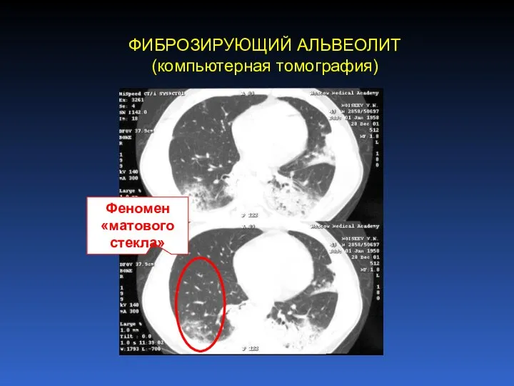 ФИБРОЗИРУЮЩИЙ АЛЬВЕОЛИТ (компьютерная томография) Феномен «матового стекла»