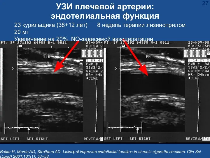 УЗИ плечевой артерии: эндотелиальная функция Butler R, Morris AD, Struthers AD.