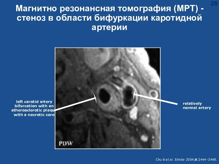 Магнитно резонансная томография (MРТ) - стеноз в области бифуркации каротидной артерии