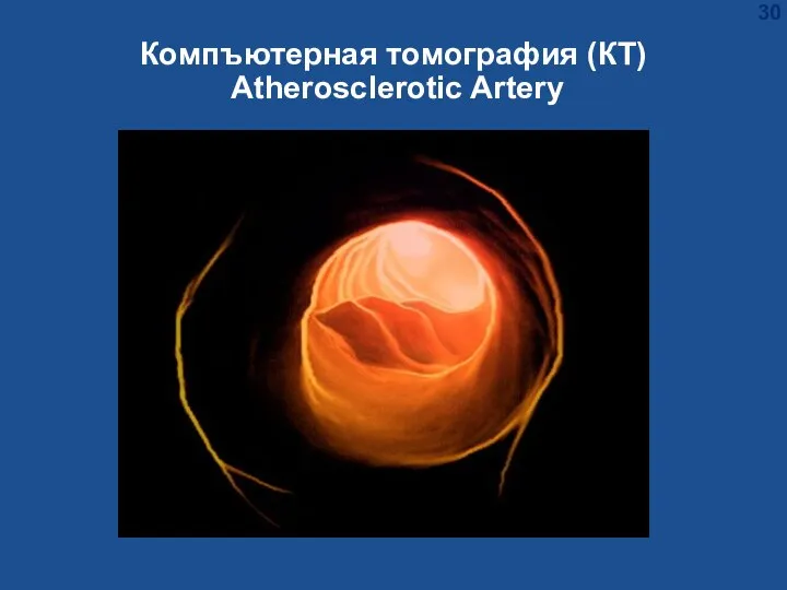 Компъютерная томография (КT) Atherosclerotic Artery
