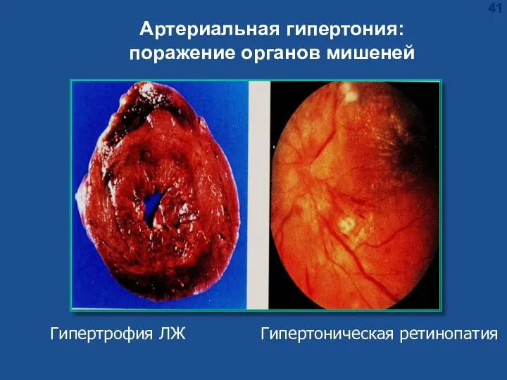Гипертрофия ЛЖ Гипертоническая ретинопатия Артериальная гипертония: поражение органов мишеней
