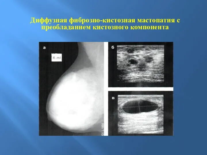 Диффузная фиброзно-кистозная мастопатия с преобладанием кистозного компонента