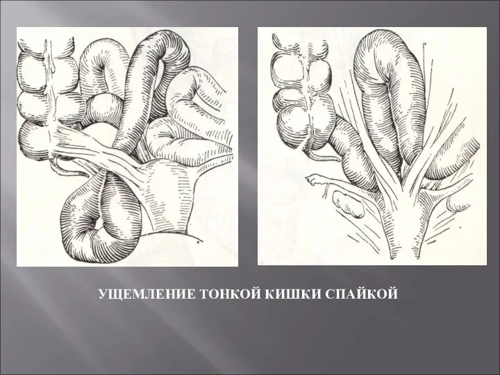 УЩЕМЛЕНИЕ ТОНКОЙ КИШКИ СПАЙКОЙ