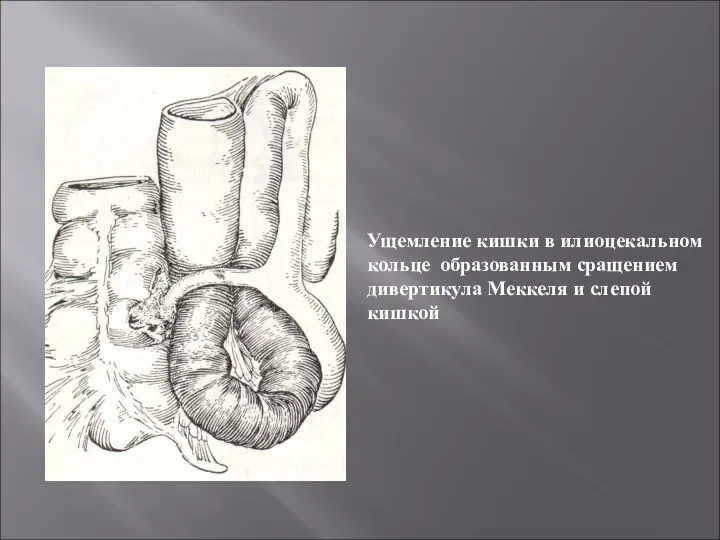 Ущемление кишки в илиоцекальном кольце образованным сращением дивертикула Меккеля и слепой кишкой