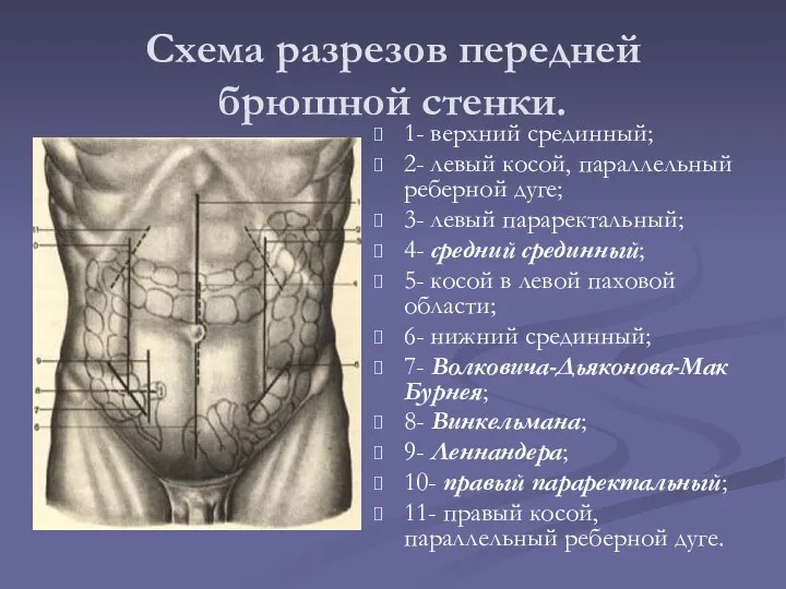 Схема разрезов передней брюшной стенки. 1- верхний срединный; 2- левый косой,