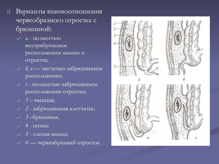 Варианты взаимоотношения червеобразного отростка с брюшиной: а - полностью внутрибрюшное расположение