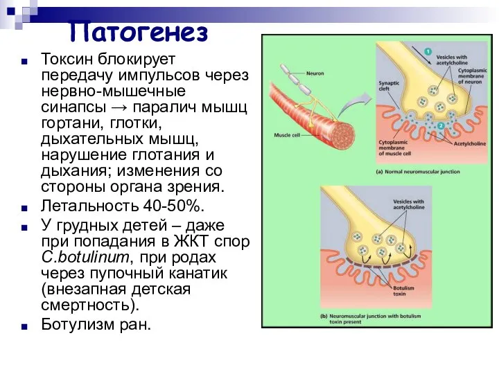 Патогенез Токсин блокирует передачу импульсов через нервно-мышечные синапсы → паралич мышц