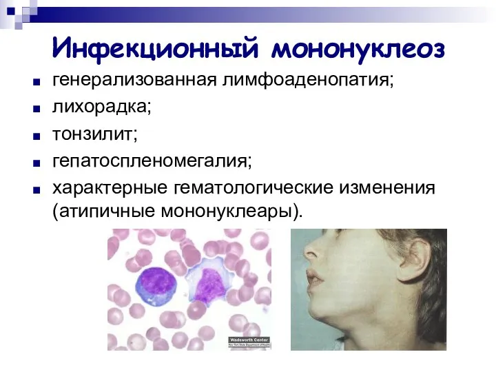 Инфекционный мононуклеоз генерализованная лимфоаденопатия; лихорадка; тонзилит; гепатоспленомегалия; характерные гематологические изменения (атипичные мононуклеары).