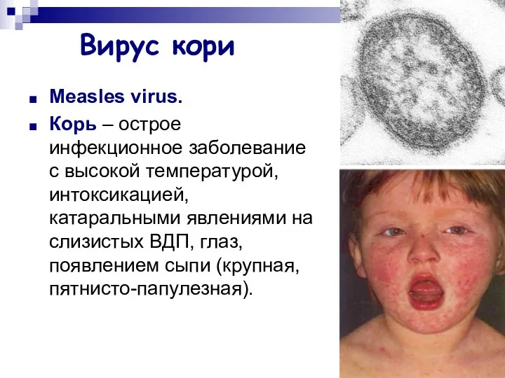 Вирус кори Measles virus. Корь – острое инфекционное заболевание с высокой