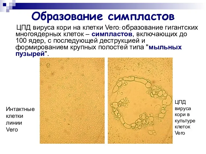 Образование симпластов ЦПД вируса кори на клетки Vero: образование гигантских многоядерных